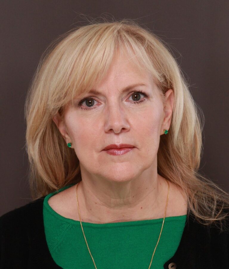 Before Image: Facelift by Dr. Thompson - front