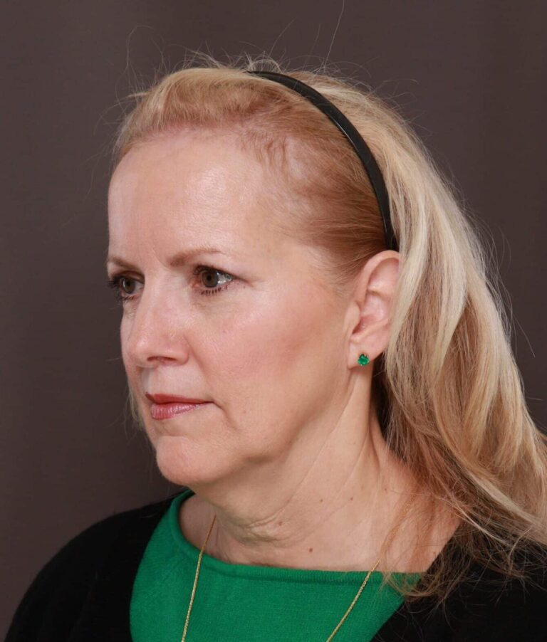 Before Image: Facelift by Dr. Thompson - left-front-oblique