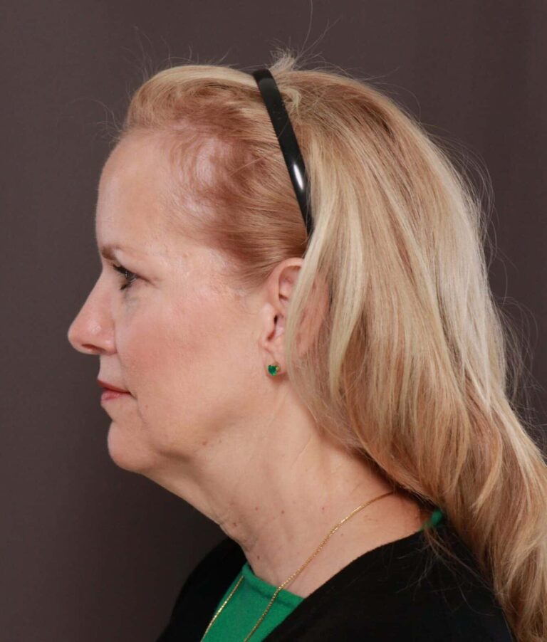 Before Image: Facelift by Dr. Thompson - left-side