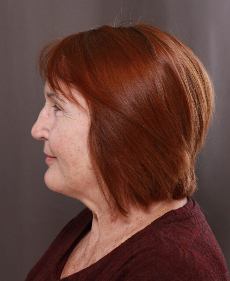 Before Image: Contour TRL by Katy Larson - left-side