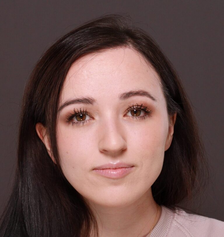 After Image: Forehead Reduction by Dr. Thompson - front
