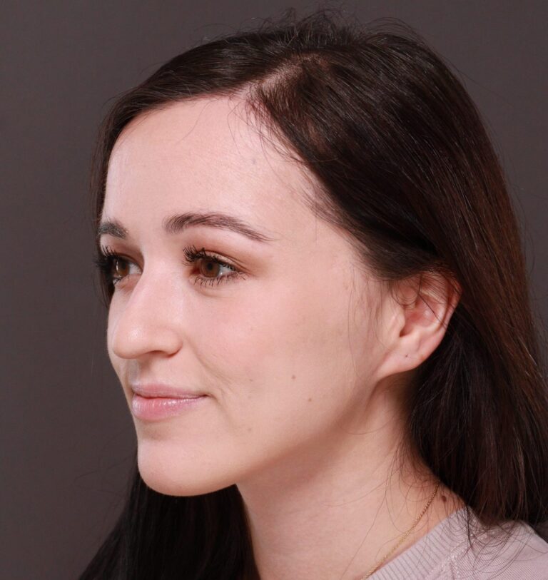 After Image: Forehead Reduction by Dr. Thompson - left-front-oblique