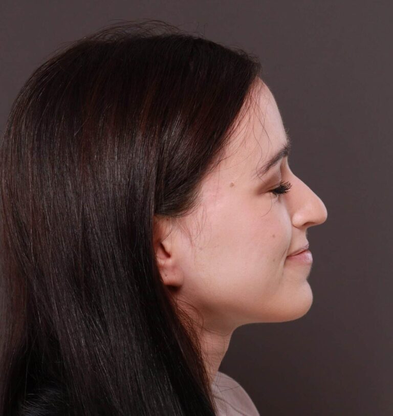 After Image: Forehead Reduction by Dr. Thompson - right-side