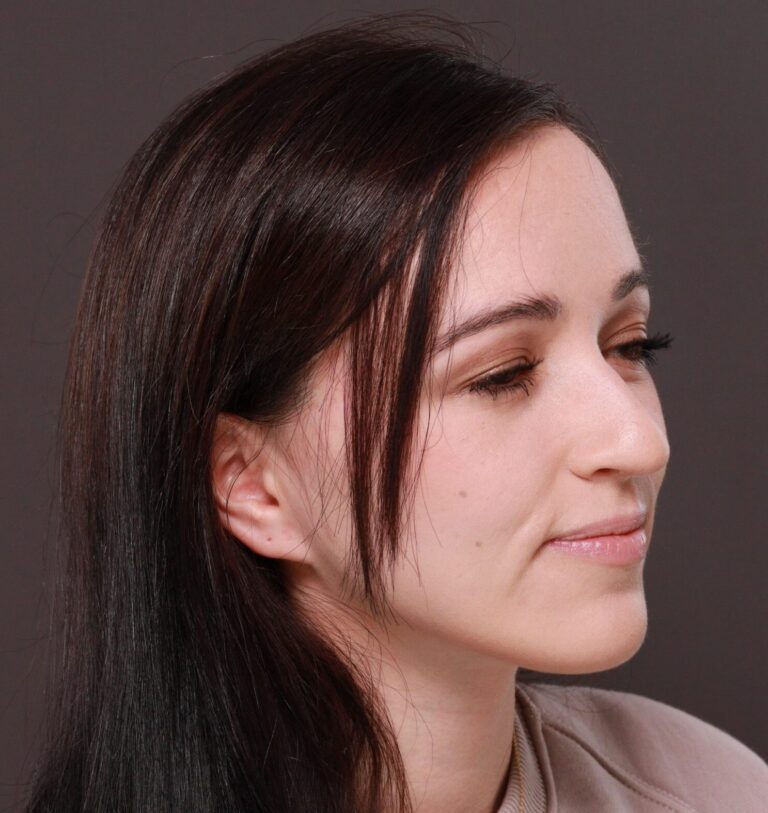 After Image: Forehead Reduction by Dr. Thompson - right-front-oblique