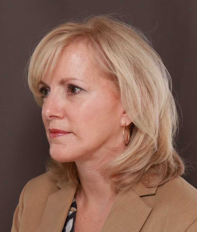 After Image: Facelift by Dr. Thompson - left-front-oblique