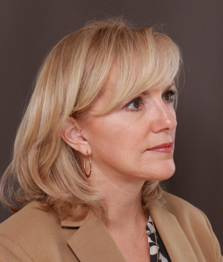 After Image: Facelift by Dr. Thompson - right-front-oblique