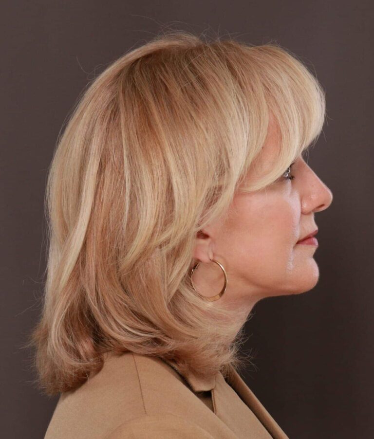 After Image: Facelift by Dr. Thompson - right-side