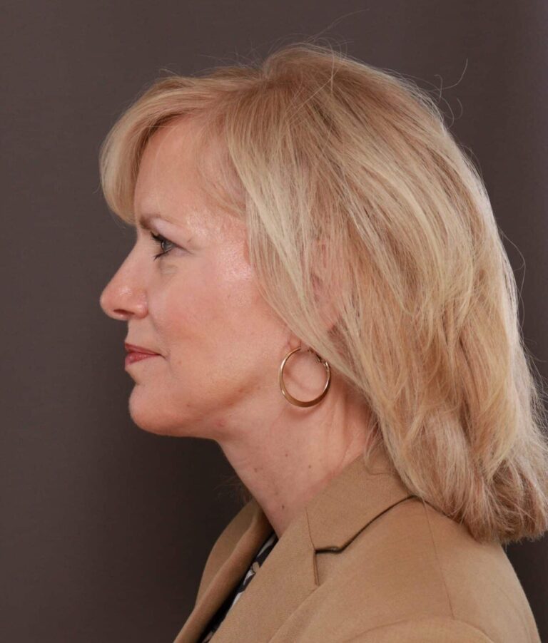 After Image: Facelift by Dr. Thompson - left-side