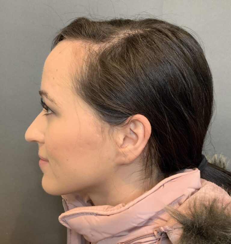 Before Image: Forehead Reduction by Dr. Thompson - left-side