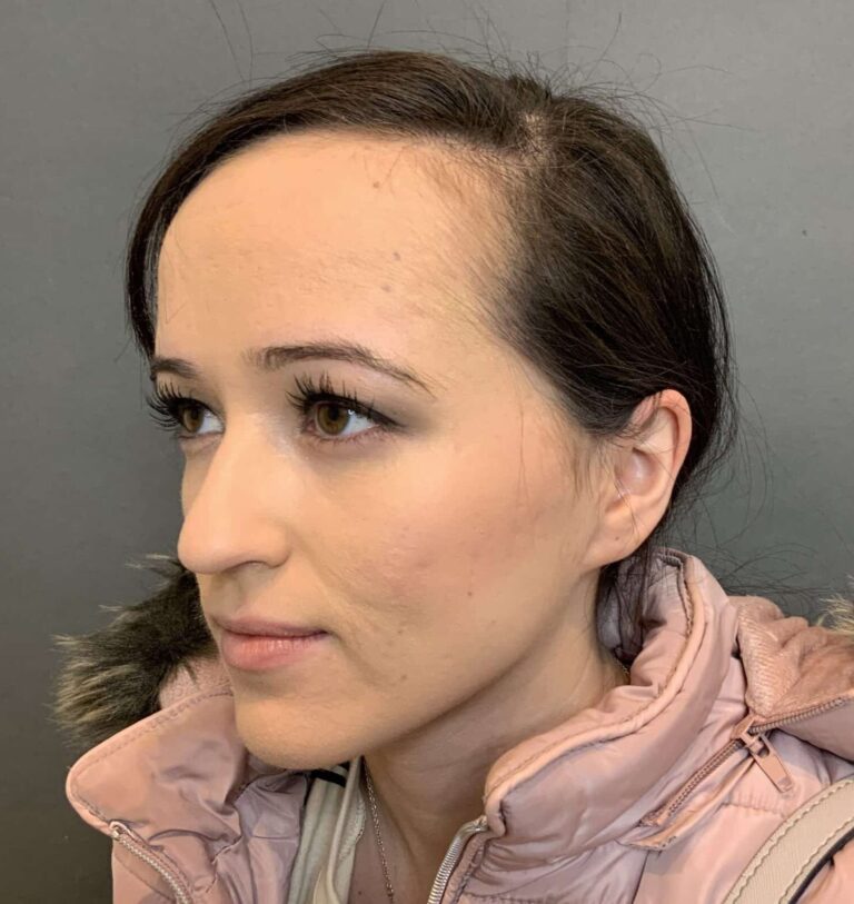 Before Image: Forehead Reduction by Dr. Thompson - left-front-oblique