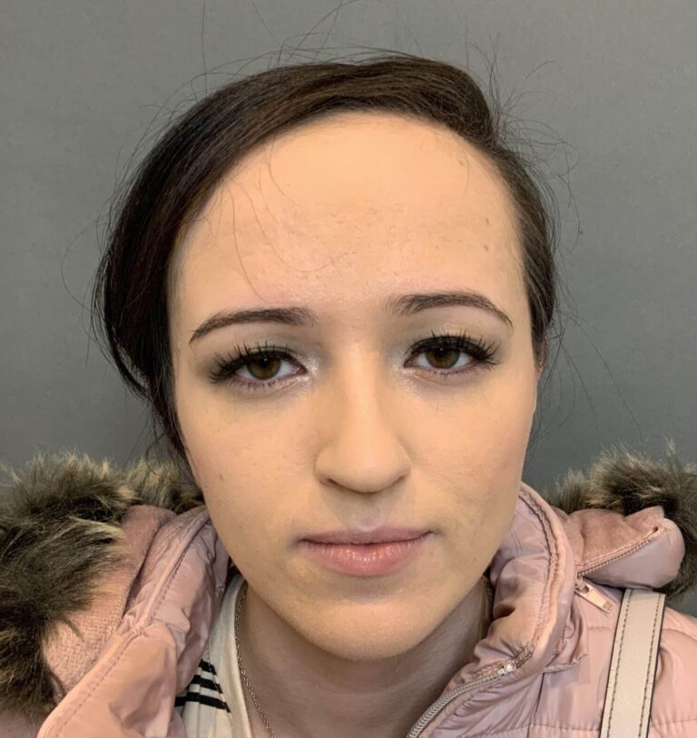 Before Image: Forehead Reduction by Dr. Thompson - front