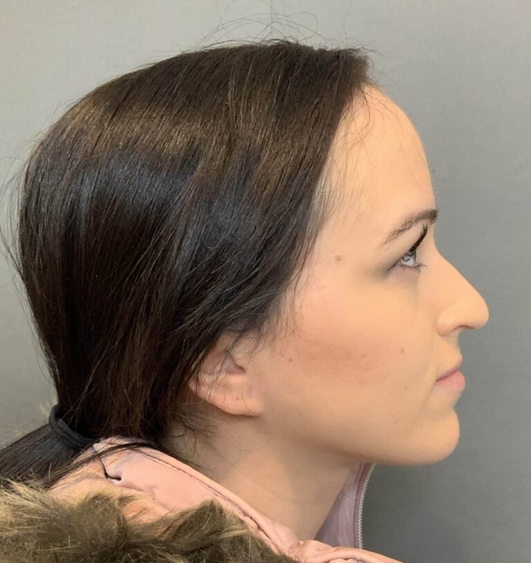 Before Image: Forehead Reduction by Dr. Thompson - right-side
