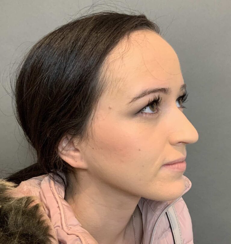 Before Image: Forehead Reduction by Dr. Thompson - right-front-oblique