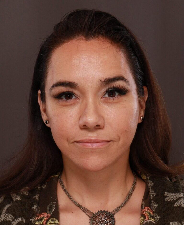 After Image: Facelift, Forehead Reduction, Upper Blepharoplasty by Dr. Thompson - front