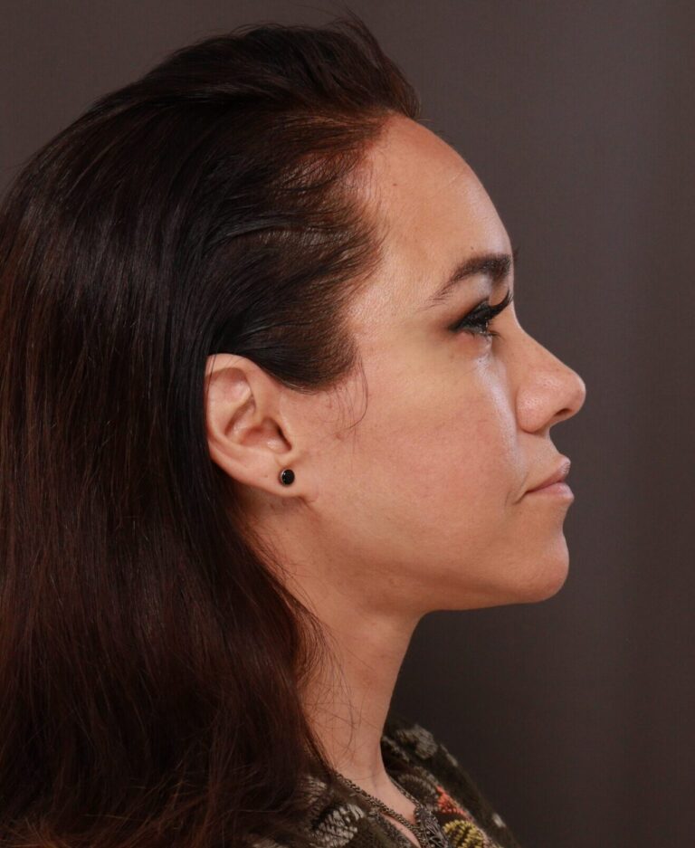 After Image: Facelift, Forehead Reduction, Upper Blepharoplasty by Dr. Thompson - right-side