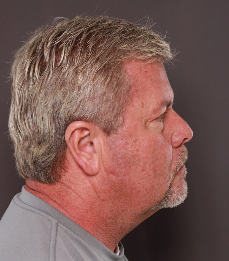 Before Image: Upper & Lower Blepharoplasty with Fat Repositioning by Dr. Henstrom -