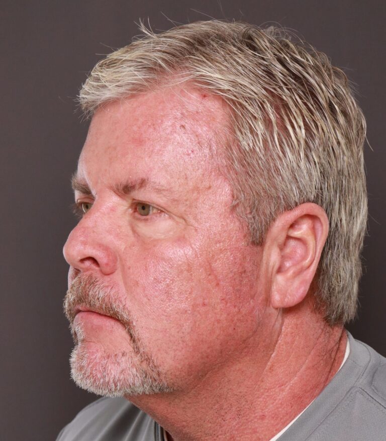 Before Image: Upper & Lower Blepharoplasty with Fat Repositioning by Dr. Henstrom - left-front-oblique