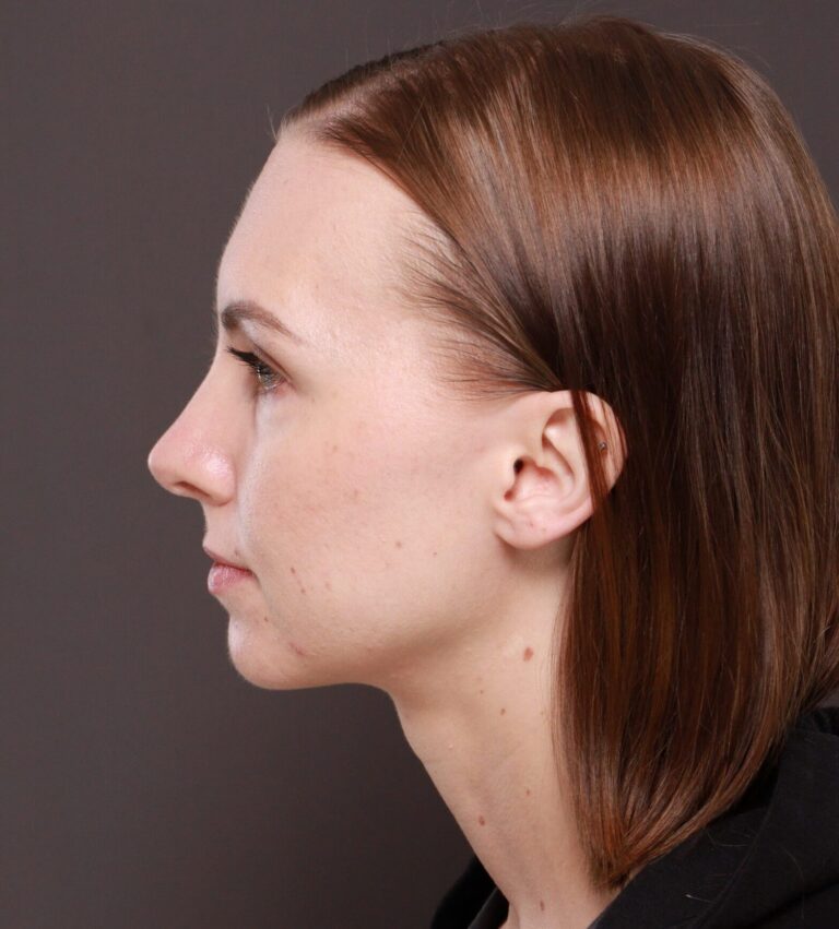 After Image: Rhinoplasty by Dr. Henstrom - left-side