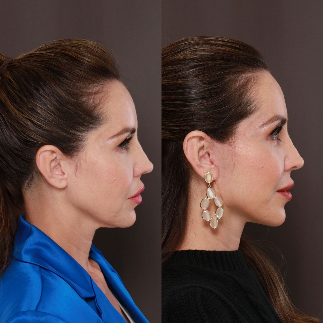 before after MACS Facelift Surgery Draper UT