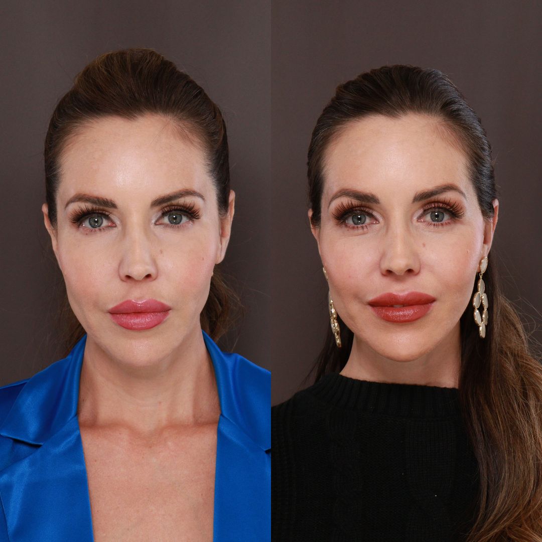 before after Mini Facelift Surgery Draper UT