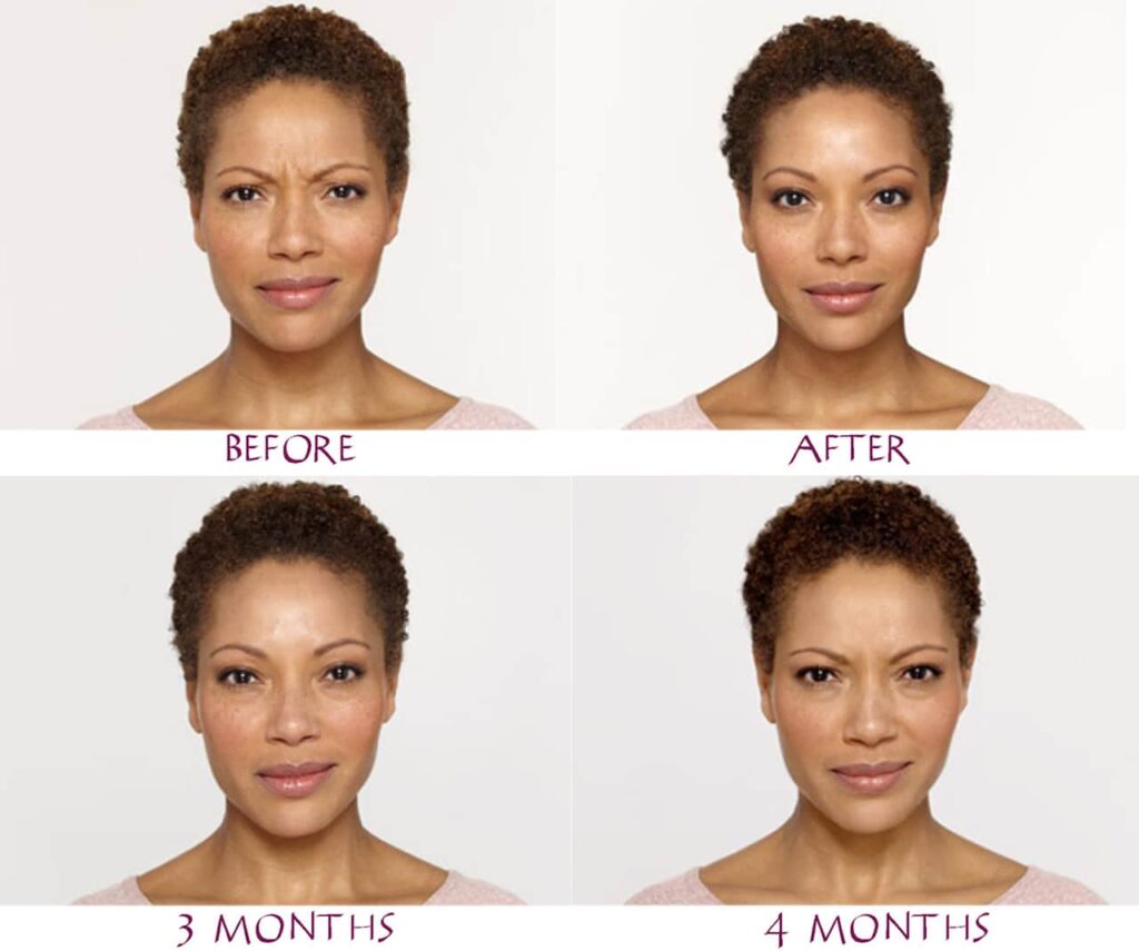 botox 4 months small