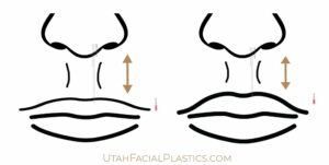lip lift image