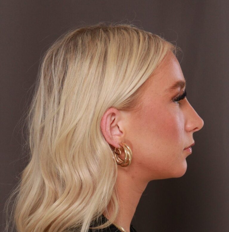 After Image: Rhinoplasty by Dr. Henstrom - right-side