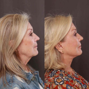 Facelift 1
