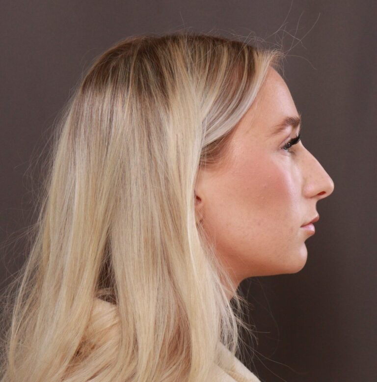 Before Image: Rhinoplasty by Dr. Henstrom - right-side