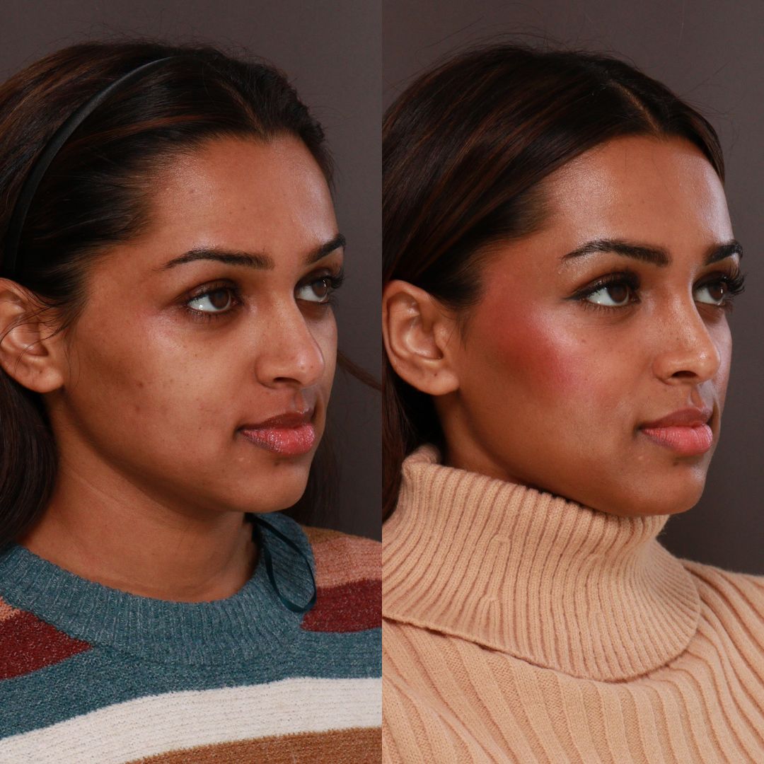 Rhinoplasty Utah Facial Plastics Salt Lake City