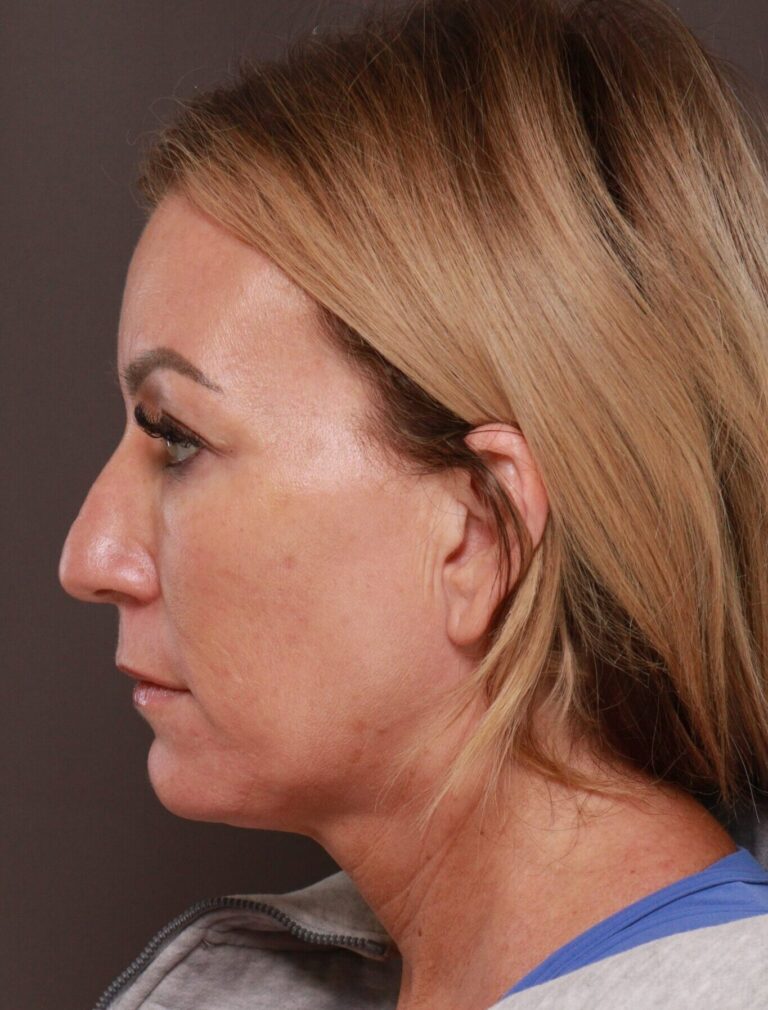 Before Image: Facelift & Rhinoplasty by Dr. Manning - left-side