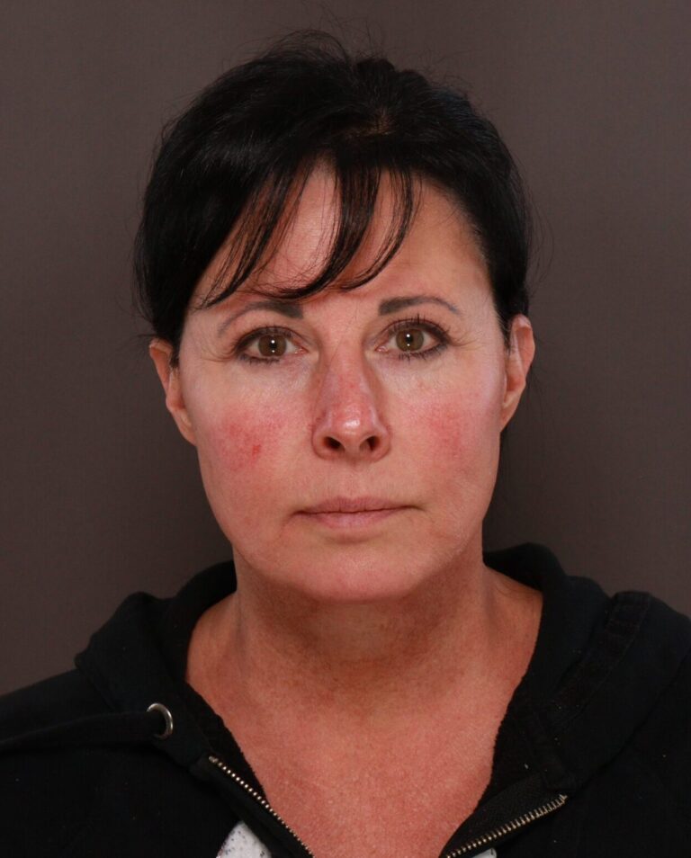 After Image: Macslift & Deep Neck Contouring by Dr. Manning - front