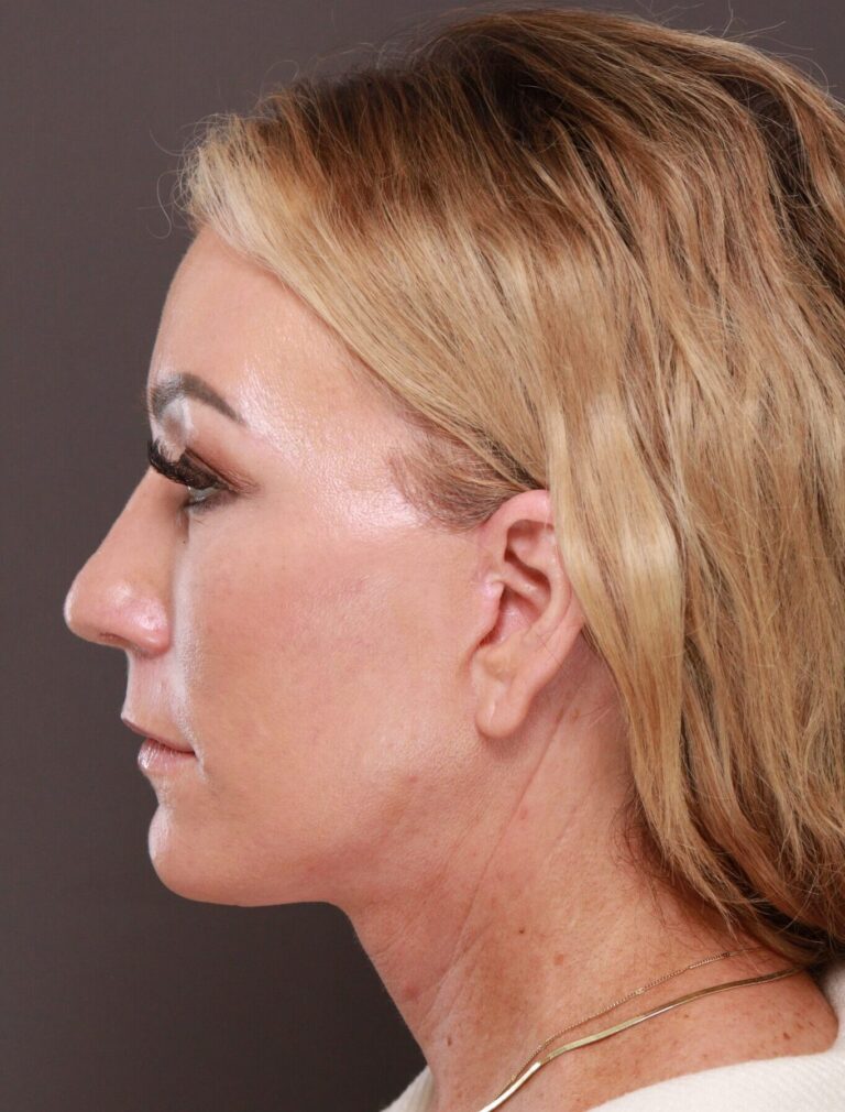 After Image: Facelift & Rhinoplasty by Dr. Manning - left-side