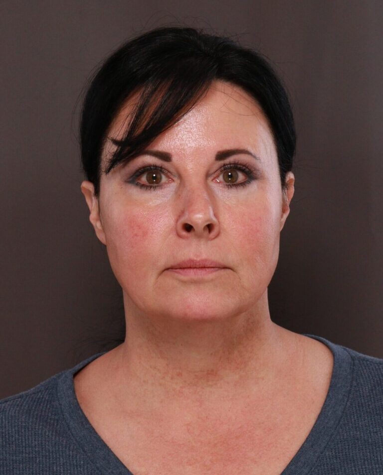 Before Image: Macslift & Deep Neck Contouring by Dr. Manning - front