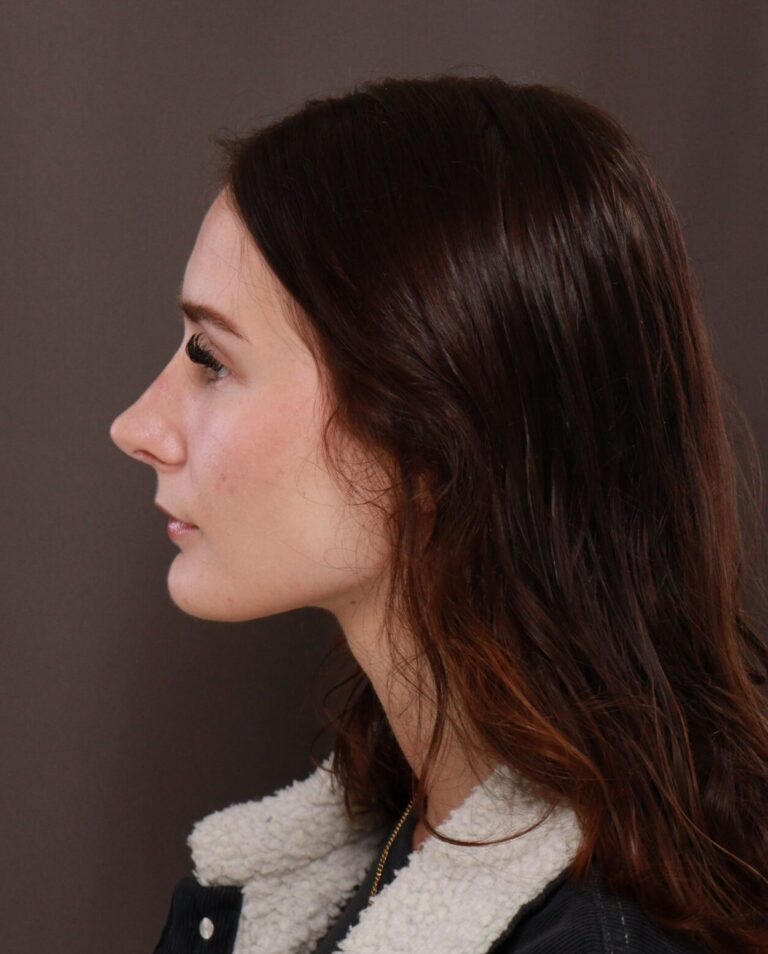After Image: Rhinoplasty by Dr. Manning - left-side