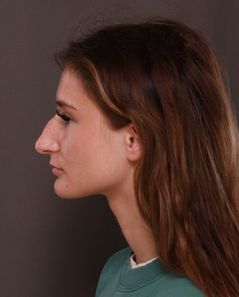 Before Image: Rhinoplasty by Dr. Manning - left-side