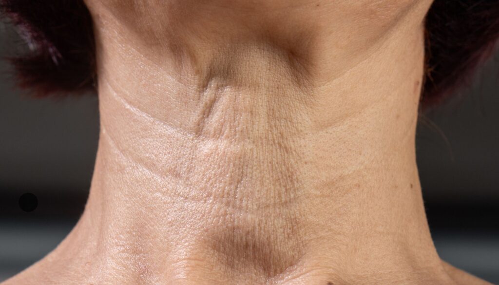 neck lift