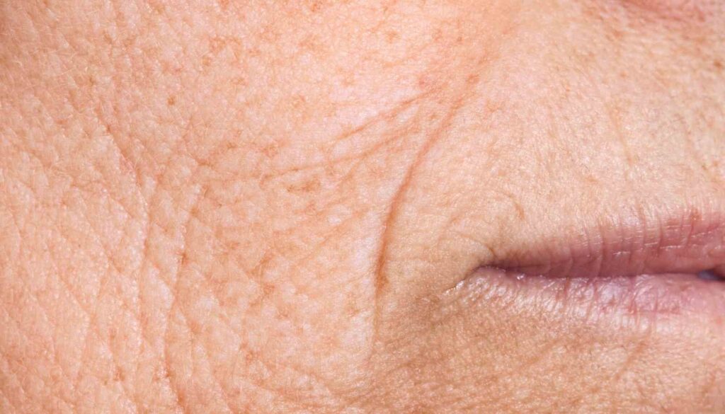 cheek lines (1)
