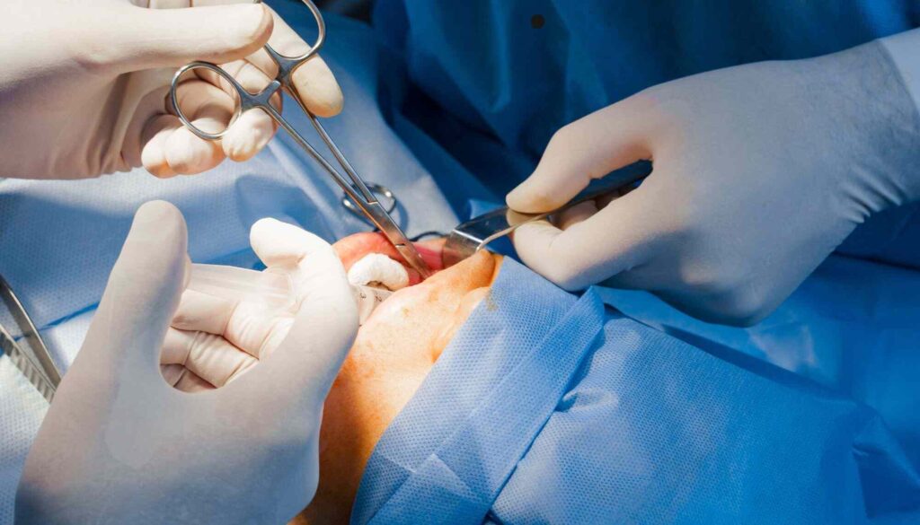 buccal fat removal