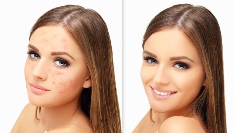 acne scars laser (1)