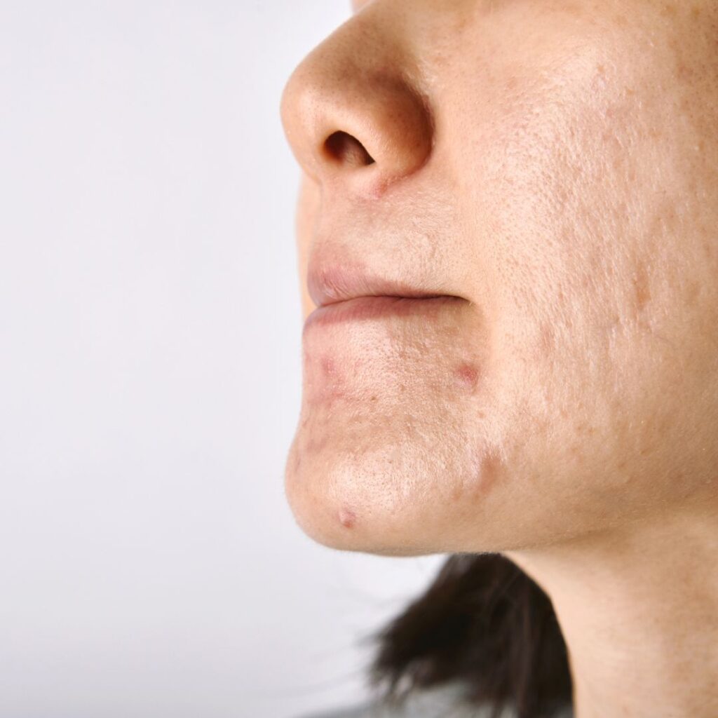 laser for acne