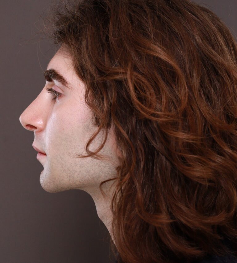 After Image: Rhinoplasty by Dr. Henstrom - left-side