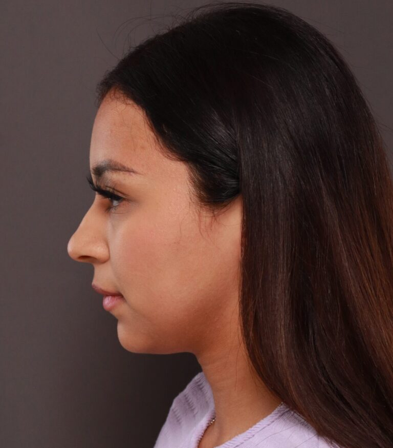 Before Image: Rhinoplasty by Dr. Manning - left-side