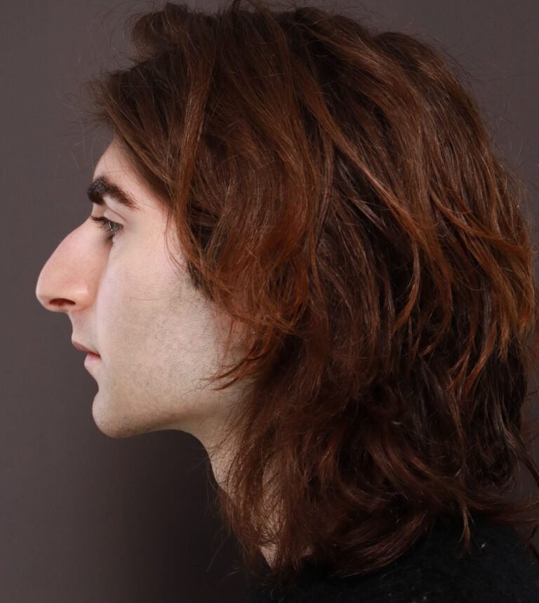Before Image: Rhinoplasty by Dr. Henstrom - left-side