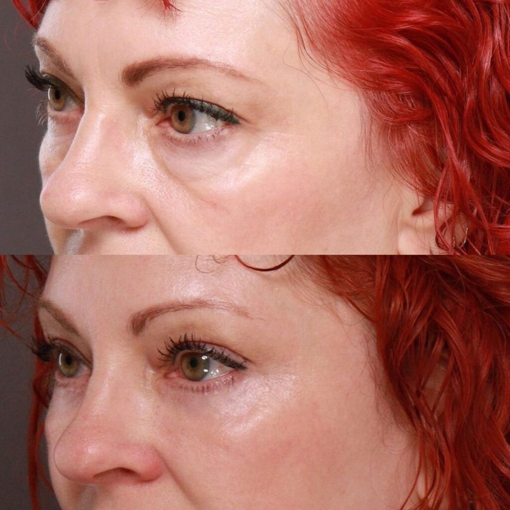 eyelid rejuvenation