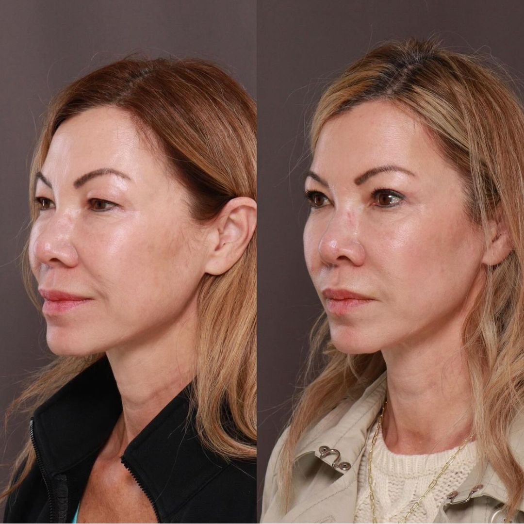 upper blepharoplasty