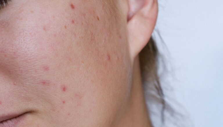 acne scars