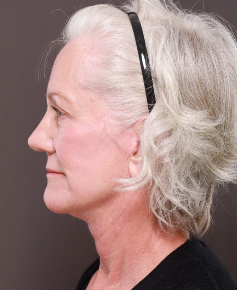 After Image: Facelift & Lower Blepharoplasty by Dr. Thompson, Contour TRL by Dr. Manning - left-side