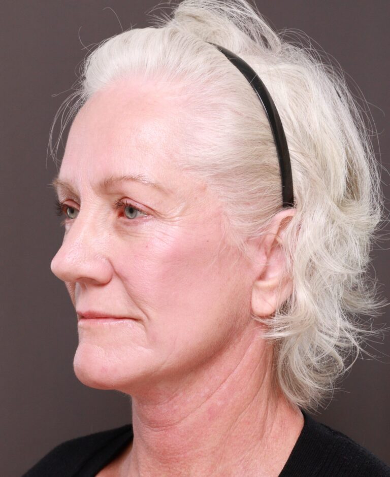 After Image: Facelift & Lower Blepharoplasty by Dr. Thompson, Contour TRL by Dr. Manning - left-front-oblique
