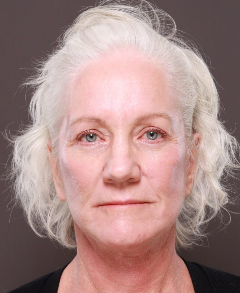 After Image: Facelift & Lower Blepharoplasty by Dr. Thompson, Contour TRL by Dr. Manning - front